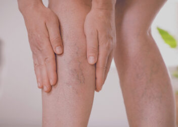Varicose veins in Ayurveda: causes, symptoms, complications, and natural treatments including herbs, Panchakarma, yoga, and lifestyle care.