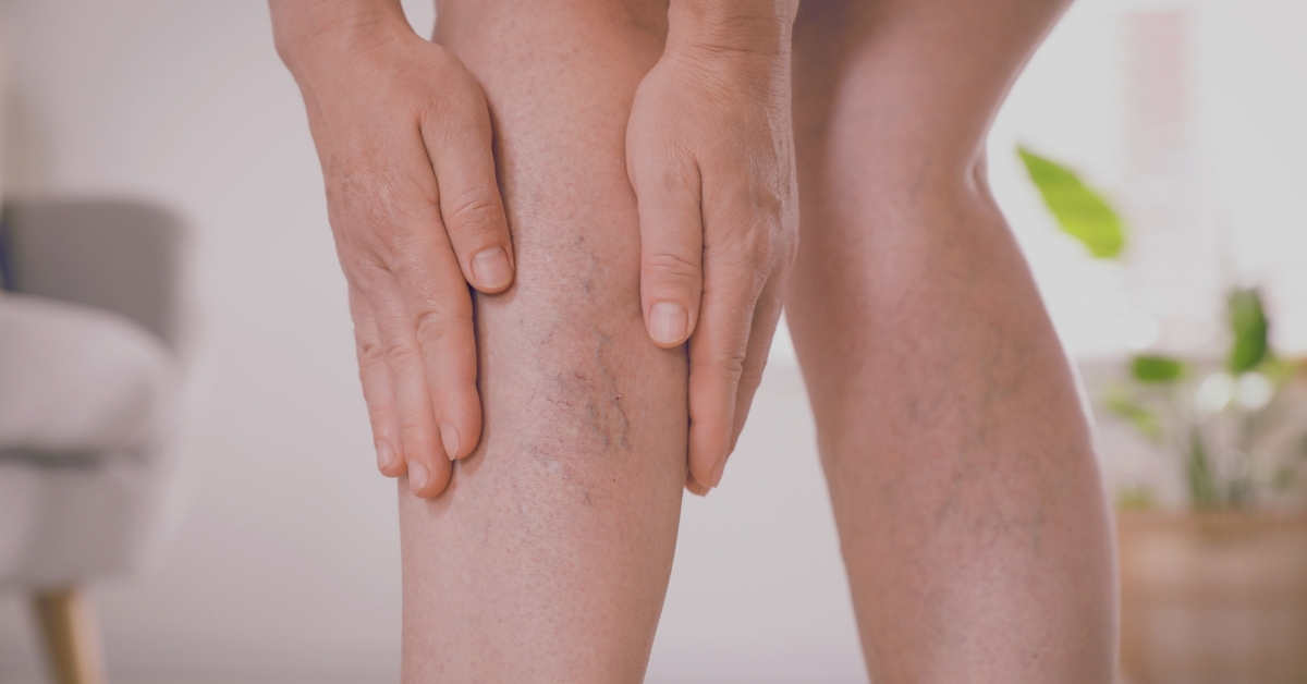 Varicose veins in Ayurveda: causes, symptoms, complications, and natural treatments including herbs, Panchakarma, yoga, and lifestyle care.